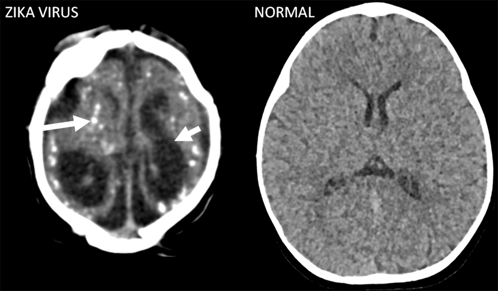 On the left is the CT image of the brain of a 4-month-old with Zika-caused microcephaly. The long arrow points to a bright white calcium deposit; other deposits are scattered through the brain. The short arrow points to a large black splotch; this is a swollen ventricle. The grey is the normal brain tissue that has managed to grow around the damaged areas. For comparison, on the right is the image of a typical 5-month-old baby’s brain; notice that it has no white calcium deposits, and the black ventricles are small and symmetrical. The entire skull is filled with normal brain tissue.