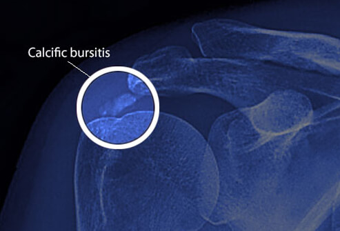 Bursitis Pictures Slideshow: Treatments for Hip, Knee Shoulder and More