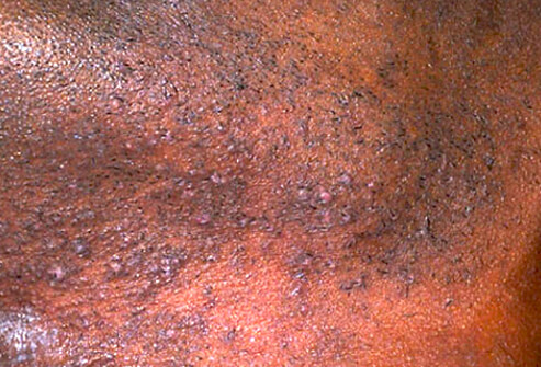 Adult Skin Diseases: Recognize These Skin Conditions?