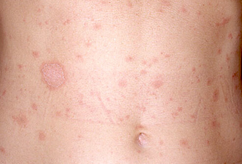 Adult Skin Diseases: Recognize These Skin Conditions?