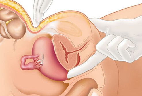 Endometriosis: Symptoms, Stages, Treatment