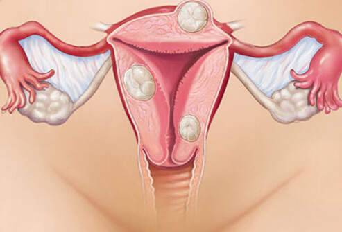 Endometriosis: Symptoms, Stages, Treatment