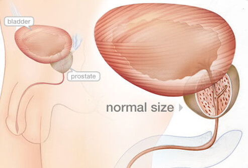 Enlarged Prostate (BPH): Symptoms, Diagnosis & Treatment