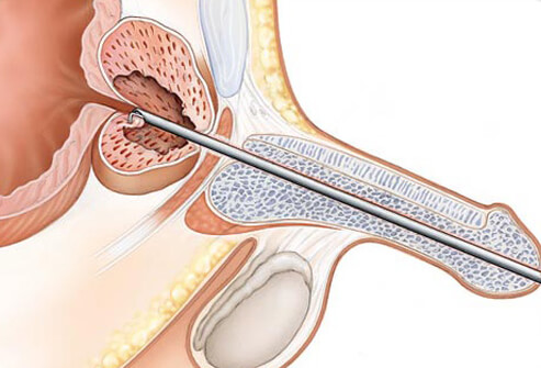 Enlarged Prostate (BPH): Symptoms, Diagnosis & Treatment