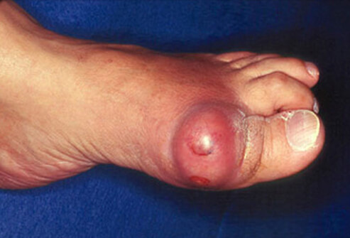 Gout: See & Learn About Gouty Arthritis Attacks