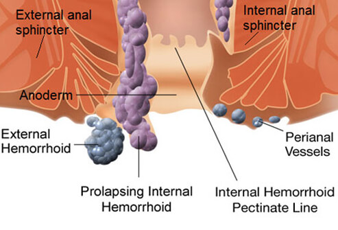 Hemorrhoids: An Illustrated Guide to Treatment