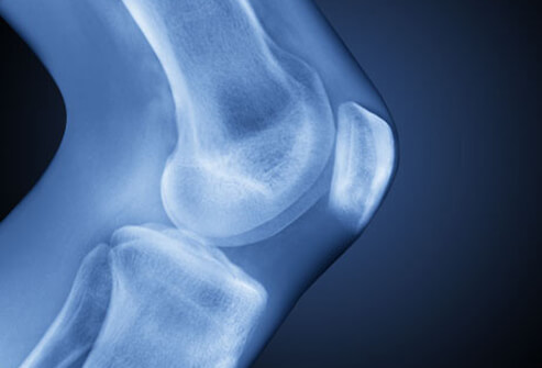 Osteoarthritis (OA): Treatment, Symptoms, Diagnosis