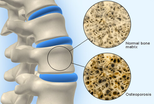 Osteoporosis: Are Your Bones at Risk?