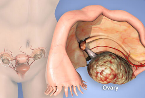 Ovarian Cancer: Symptoms, Stages, Treatments and Risks