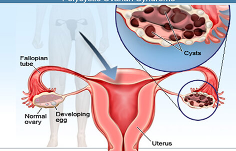 Ovarian Cysts: Are Ovarian Cysts Cancer?