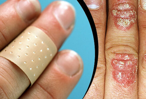 Skin Problems: 10 Psoriasis Triggers and Treatments