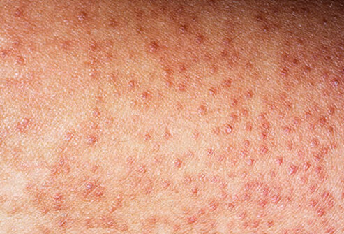Skin Problems: Rashes, Bumps and Lumps