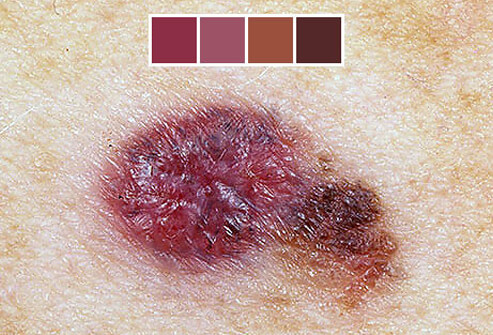 Skin Cancer: What Skin Cancer Looks Like