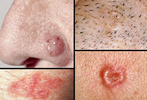 Skin Cancer: What Skin Cancer Looks Like