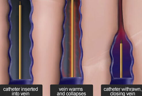 Spider & Varicose Veins: See The Before-and-After Photos