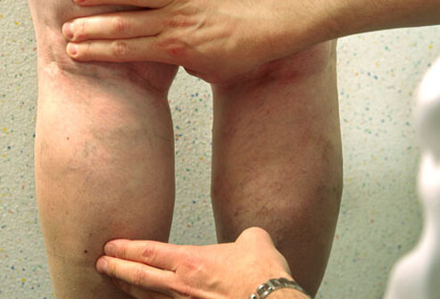 Spider & Varicose Veins: See The Before-and-After Photos