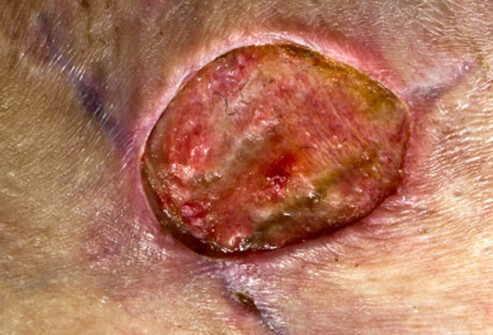 Staph Infection: Images & Symptoms of Staphylococcal Disease