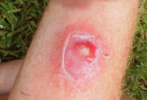 Staph Infection: Images & Symptoms of Staphylococcal Disease