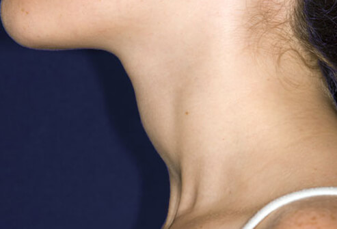 Thyroid: Common Thyroid Problems Explained