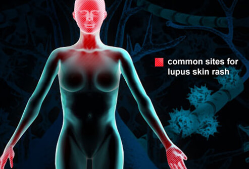 Lupus: Symptoms, Rash, and Treatment