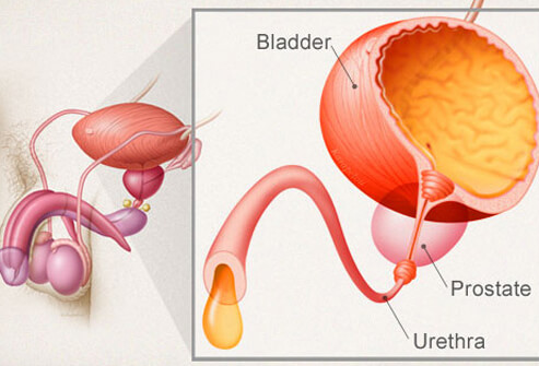 Urinary Incontinence in Men: Products, Diet, & Lifestyle