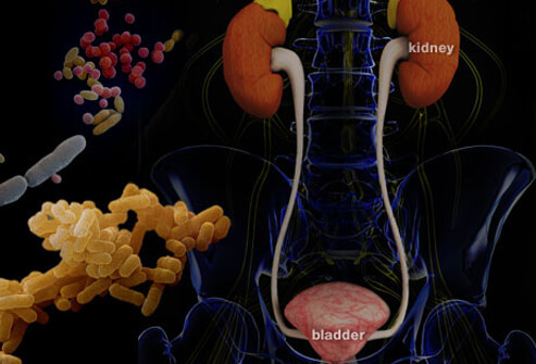 Urinary Tract Infection: Bladder Infection Symptoms, Causes and Treatments