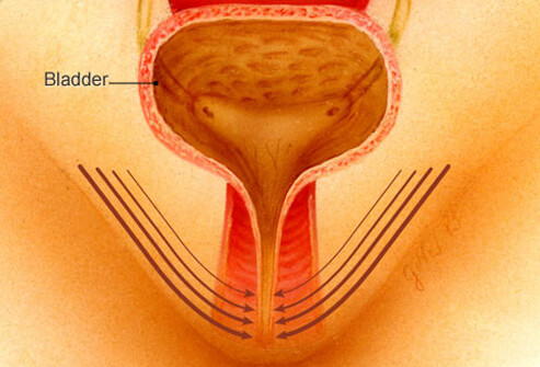 Urinary Incontinence in Women: Loss of Bladder Control?