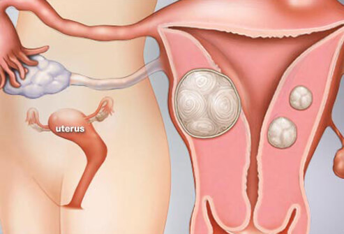 Women’s Health: A Visual Guide to Uterine Fibroids