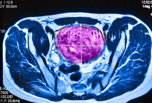 Women’s Health: A Visual Guide to Uterine Fibroids